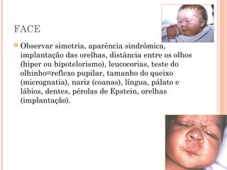 FACE
 Observar simetria, aparência sindrômica,
implantação das orelhas, distância entre os olhos
(hiper ou hipotelorismo), leucocorias, teste do
olhinho=reflexo pupilar, tamanho do queixo
(micrognatia), nariz (coanas), língua, pálato e
lábios, dentes, pérolas de Epstein, orelhas
(implantação).
 