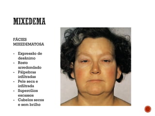 FÁCIES
MIXEDEMATOSA
- Expressão de
desânimo
- Rosto
arredondado
- Pálpebras
infiltradas
- Pele seca e
infiltrada
- Supercílios
escassos
- Cabelos secos
e sem brilho
 