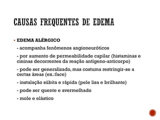 § EDEMA ALÉRGICO
- acompanha fenômenos angioneuróticos
- por aumento de permeabilidade capilar (histaminas e
cininas decorrentes da reação antígeno-anticorpo)
- pode ser generalizado, mas costuma restringir-se a
certas áreas (ex.:face)
- instalação súbita e rápida (pele lisa e brilhante)
- pode ser quente e avermelhado
- mole e elástico
 