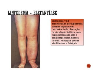 Elefantíase = Sd
caracterizada por hipertrofia
cutânea regional em
decorrência de obstrução
da circulação linfática, com
represamento de linfa e
proliferação fibroblástica
intensa. Principais causas
são Filariose e Erisipela
 