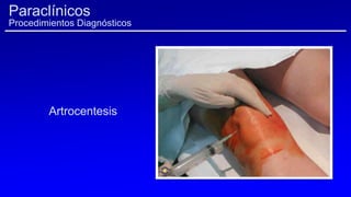 Artrocentesis
Paraclínicos
Procedimientos Diagnósticos
 