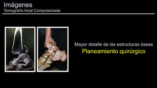 Mayor detalle de las estructuras óseas
Planeamiento quirúrgico
Imágenes
Tomografía Axial Computarizada
 