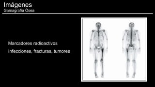 Marcadores radioactivos
Infecciones, fracturas, tumores
Imágenes
Gamagrafía Ósea
 