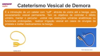 Cateterismo Vesical de Demora
É a introdução de um cateter com “cuff’’, através da uretra até a bexiga, para
esvaziamento vesical permanente. Tem os objetivos de controlar o débito
urinário, manter o percurso uretral nas obstruções urinárias anatômicas ou
funcionais prolongadas, realizar irrigação vesical em casos de cirurgias da
próstata e instilar medicamentos na bexiga.
medway.com.br
Fonte: www.sanar.com.br
 