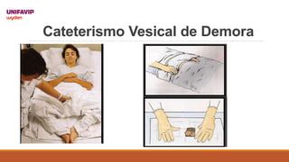 Cateterismo Vesical de Demora
 
