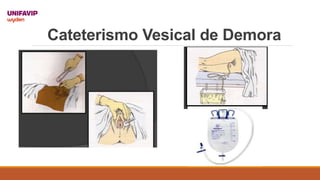 Cateterismo Vesical de Demora
 