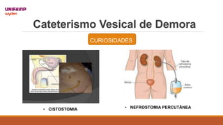 Cateterismo Vesical de Demora
• CISTOSTOMIA
CURIOSIDADES
• NEFROSTOMIA PERCUTÂNEA
 