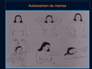 Autoexamen de mamas
 
