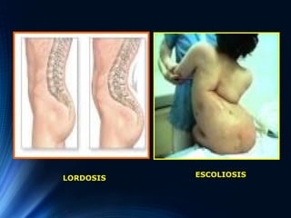 LORDOSIS ESCOLIOSIS
 