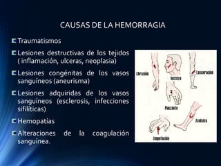CAUSAS DE LA HEMORRAGIA
Traumatismos
Lesiones destructivas de los tejidos
( inflamación, ulceras, neoplasia)
Lesiones congénitas de los vasos
sanguíneos (aneurisma)
Lesiones adquiridas de los vasos
sanguíneos (esclerosis, infecciones
sifilíticas)
Hemopatías
Alteraciones de la coagulación
sanguínea.
 