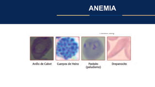 ANEMIA
 