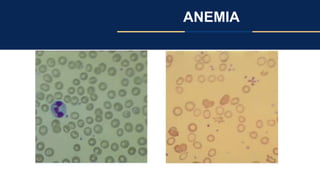 ANEMIA
 