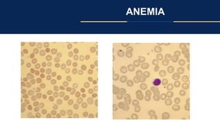 ANEMIA
 