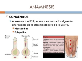ANAMNESIS
 CONGÉNITOS
 Al examinar al RN podemos encontrar las siguientes
alteraciones de la desembocadura de la uretra.
 Hipospadias
 Epispadias
 