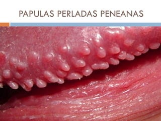 PAPULAS PERLADAS PENEANAS
 