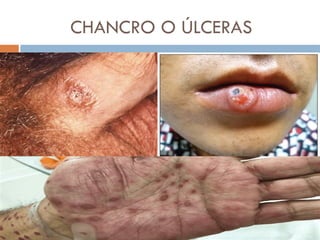 CHANCRO O ÚLCERAS
 