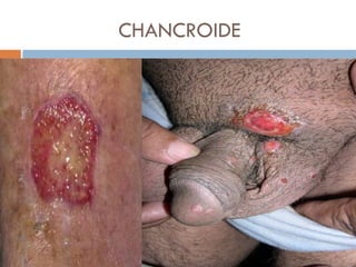 CHANCROIDE
 