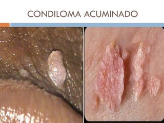 CONDILOMA ACUMINADO
 