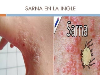 SARNA EN LA INGLE
 