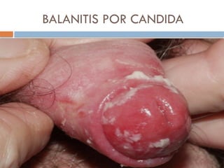 BALANITIS POR CANDIDA
 