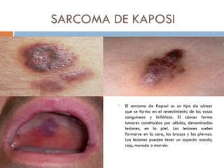 SARCOMA DE KAPOSI
 El sarcoma de Kaposi es un tipo de cáncer
que se forma en el revestimiento de los vasos
sanguíneos y linfáticos. El cáncer forma
tumores constituidos por células, denominados
lesiones, en la piel. Las lesiones suelen
formarse en la cara, los brazos y las piernas.
Las lesiones pueden tener un aspecto rosado,
rojo, morado o marrón.
 