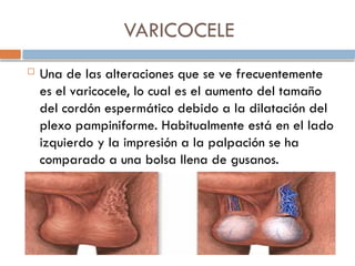 VARICOCELE
 Una de las alteraciones que se ve frecuentemente
es el varicocele, lo cual es el aumento del tamaño
del cordón espermático debido a la dilatación del
plexo pampiniforme. Habitualmente está en el lado
izquierdo y la impresión a la palpación se ha
comparado a una bolsa llena de gusanos.
 