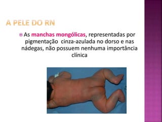  As manchas mongólicas, representadas por
pigmentação cinza-azulada no dorso e nas
nádegas, não possuem nenhuma importância
clínica
 