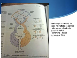 Hemianopsia – Perda da
visão na metade do campo
Heterônimia – lesão do
quiasma óptico
Homônima – lesão
retroquiasmática
 