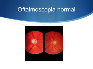 Oftalmoscopia normal
 