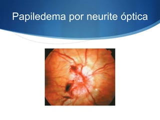 Papiledema por neurite óptica
 