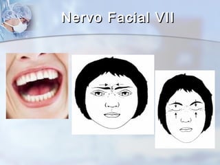 Nervo Facial VIINervo Facial VII
 