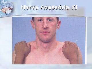 Nervo Acessório XINervo Acessório XI
 