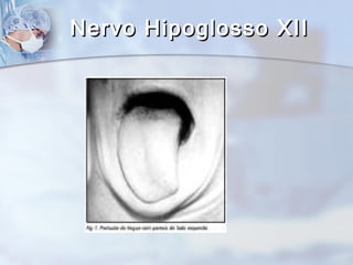 Nervo Hipoglosso XIINervo Hipoglosso XII
 
