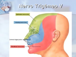 Nervo Trigêmeo VNervo Trigêmeo V
 