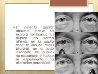  El    defecto   pupilar
  aferente relativo, se
  explora iluminando las
  pupilas    en    forma
  alterna, en la pupila
  sana se induce miosis
  bilateral, en el lado
  lesionado, las pupilas
  no responden e incluso
  se experimenta una
  dilatación paradójica
 