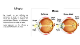 Miopía
La miopía es un defecto de
refracción o error en el enfoque
visual. Las imágenes se enfocan por
delante de la retina y no sobre ella,
lo que dificulta la visión de lejos.
suele aparecer en la infancia y
evoluciona hasta los 20 años
 