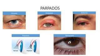 PARPADOS
Orzuelo Chalazion blefaritiz
Triquiasis Distiquiasis
 