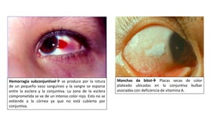 Hemorragia subconjuntival se produce por la rotura
de un pequeño vaso sanguíneo y la sangre se esparce
entre la esclera y la conjuntiva. La zona de la esclera
comprometida se ve de un intenso color rojo. Esto no se
extiende a la córnea ya que no está cubierta por
conjuntiva.
Manchas de bitot Placas secas de color
plateado ubicadas en la conjuntiva bulbar
asociadas con deficiencia de vitamina A.
 