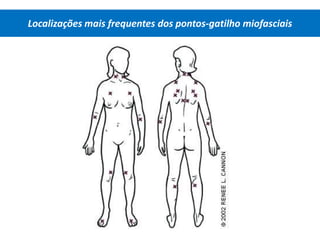 Localizações mais frequentes dos pontos-gatilho miofasciais
 