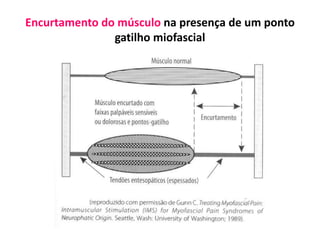 Encurtamento do músculo na presença de um ponto
gatilho miofascial
 