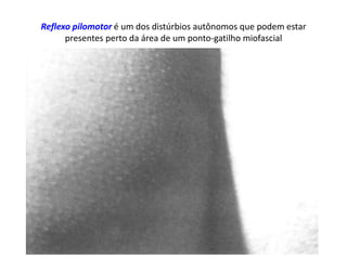 Reflexo pilomotor é um dos distúrbios autônomos que podem estar
presentes perto da área de um ponto-gatilho miofascial
 