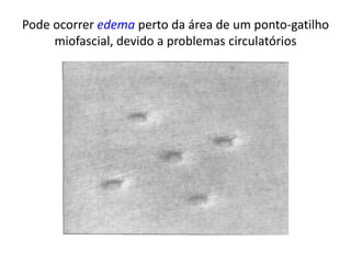 Pode ocorrer edema perto da área de um ponto-gatilho
miofascial, devido a problemas circulatórios
 