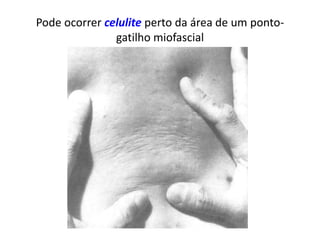Pode ocorrer celulite perto da área de um ponto-
gatilho miofascial
 