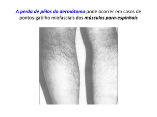 A perda de pêlos do dermátomo pode ocorrer em casos de
pontos-gatilho miofasciais dos músculos para-espinhais
 