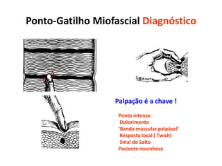 Ponto-Gatilho Miofascial Diagnóstico
Palpação é a chave !
Ponto intenso
Dolorimento
‘Banda muscular palpável’
Resposta local ( Twich)
Sinal do Salto
Paciente reconhece
 