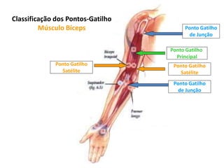 Ponto Gatilho
Principal
Ponto Gatilho
Satélite
Ponto Gatilho
Satélite
Ponto Gatilho
de Junção
Ponto Gatilho
de Junção
Classificação dos Pontos-Gatilho
Músculo Bíceps
 