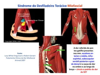 Síndrome do Desfiladeiro Torácico Miofascial
A dor referida de pon
tos-gatilho presentes
nos mm. escaleno an-
terior e médio, infra-
espinhal, subescapular
serrátil posterior e gran
de dorsal é a causa de dor
no ombro e ao longo do
braço – simula o padrão de dor
da SDT
Fonte:
Lucy White Fergunson e Robert Gerwin
Tratamento Clínico da Dor Miofascial
Artmed 2007
 