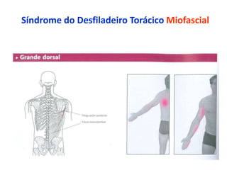 Síndrome do Desfiladeiro Torácico Miofascial
 