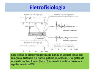 Eletrofisiologia
Característica eletromiográfica da banda muscular tensa em
relação à distância do ponto-gatilho miofascial. O registro da
resposta contrátil local (twitch) somente é obtido quando a
agulha acerta o PG1.
 