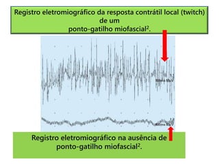 Registro eletromiográfico da resposta contrátil local (twitch)
de um
ponto-gatilho miofascial2.
Registro eletromiográfico na ausência de
ponto-gatilho miofascial2.
 